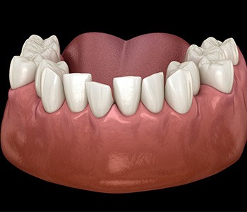 Illustration of crowded teeth