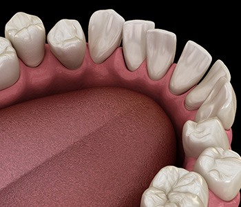 Illustration of gapped teeth