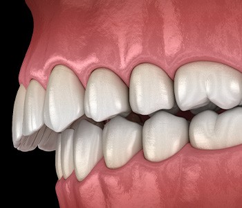 Illustration of an overbite
