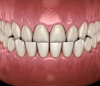 Illustration of an underbite