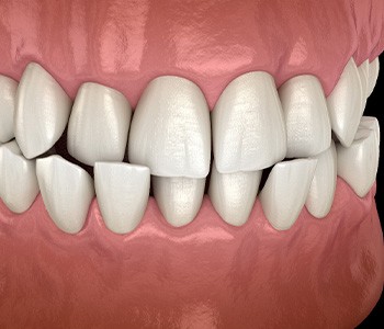 Illustration of a crossbite