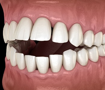 Illustration of an open bite