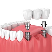 Illustration of implant bridge in Worcester