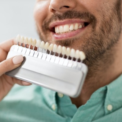 Man's smile compared with porcelain veneers color chart