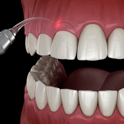 Animated smile during gum recontouring treatment