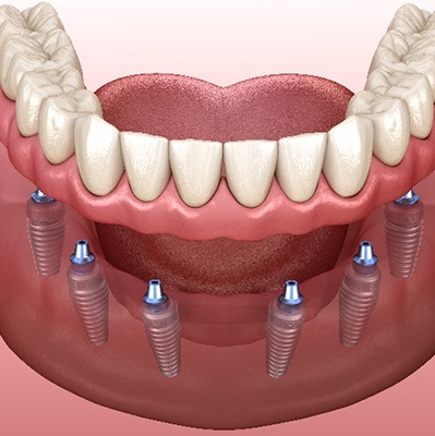 Illustration of implant dentures being placed on bottom teeth