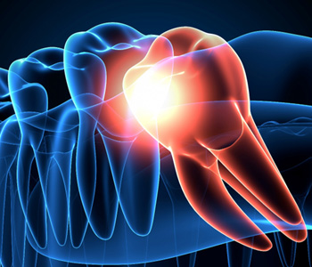 a 3D illustration showing an impacted wisdom tooth