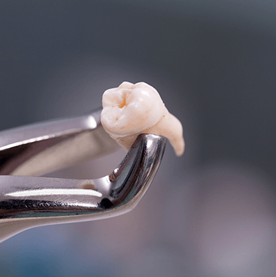 a closeup of forceps holding a tooth