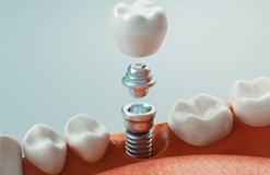 Illustration of different parts of a dental implant