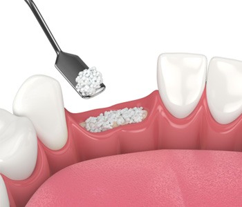 a 3D render of a dental bone graft procedure
