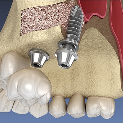 Animated smile after bone grafting and dental implant post placement