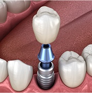 Animated smile during dental implant supported dental crown placement