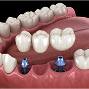 Animated smile during dental implant supported fixed bridge placement