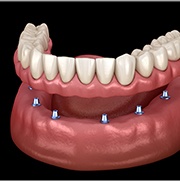 Animated smile during dental implant supported denture placement