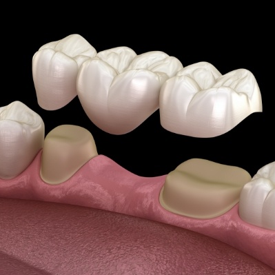 Animated smile during fixed bridge placement