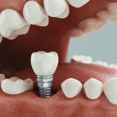 Animated smile during dental implant supported dental crown placement