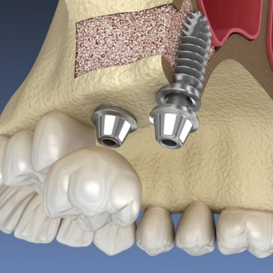 Animated smile after pre-prosthetic dental implant preparation surgery