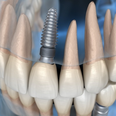 Animated smile with dental implant supported dental crown