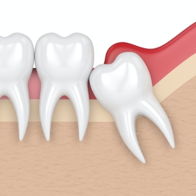 Animated smile with impacted wisdom tooth before extraction