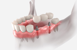a 3D illustration showing the dental implant process