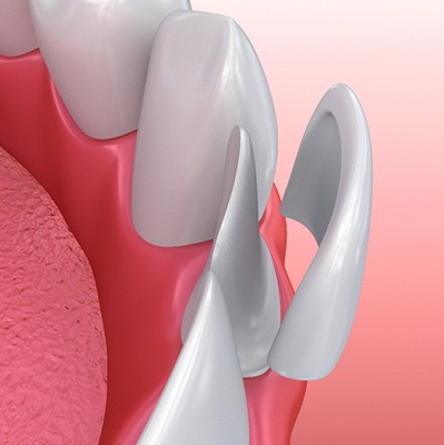 Illustration of veneer in Worcester being placed