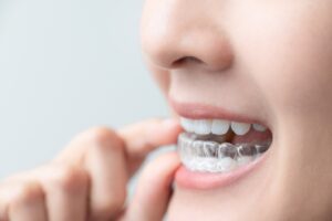 Person inserting an Invisalign aligner